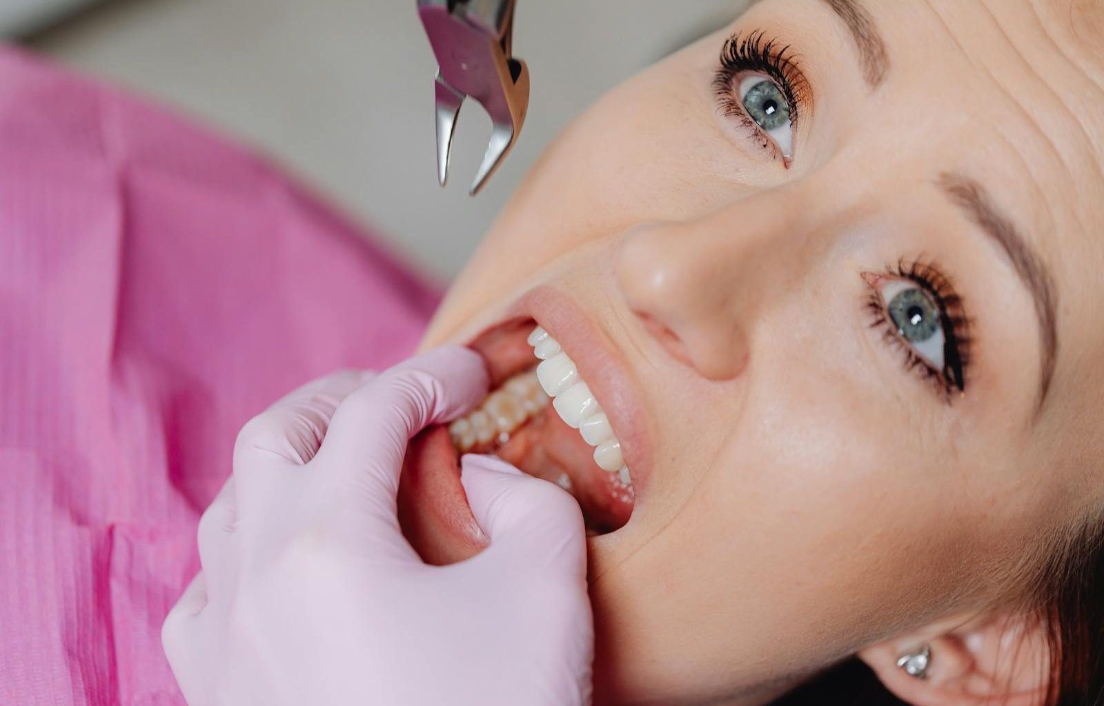 wisdom tooth extraction