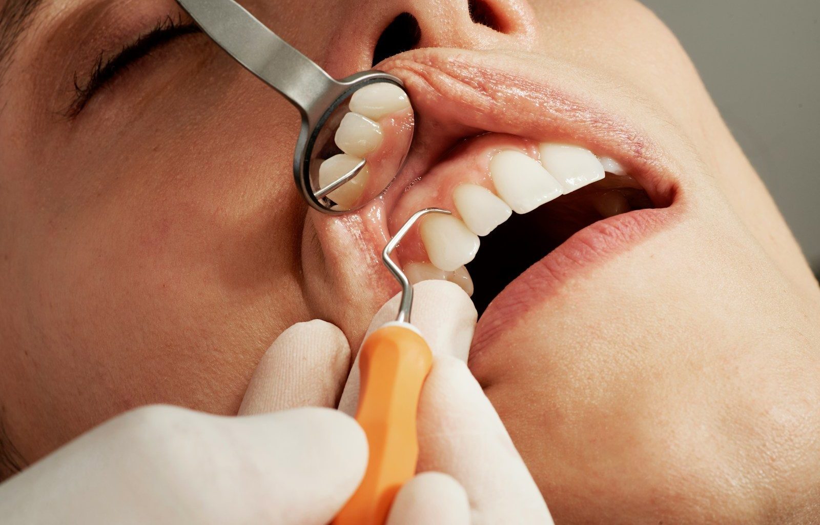gum graft surgery