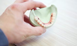 zygomatic dental implant