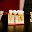 bone grafting for dental implant