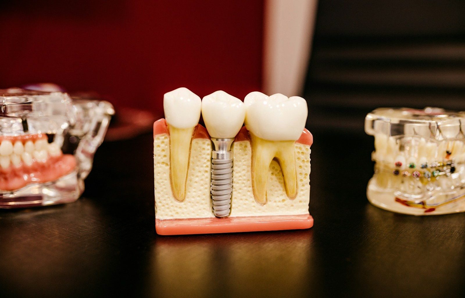 bone grafting for dental implant