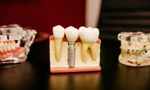 bone grafting for dental implant