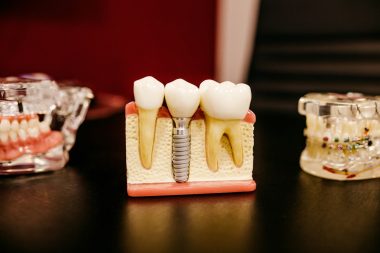 bone grafting for dental implant