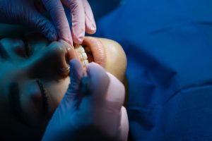 Contenção ortodôntica: por quanto tempo é preciso usar?